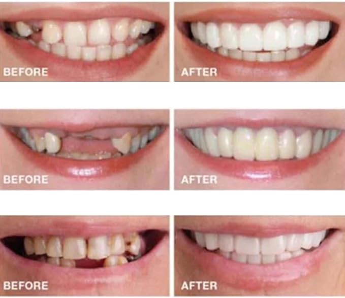 SMYL Silicone Teeth – 2 Upper & 2 Lower Pairs